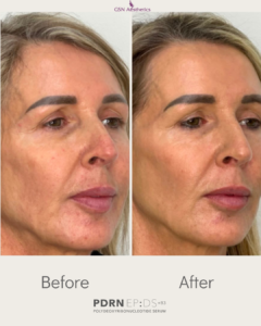 Before and after of pdrn treatments